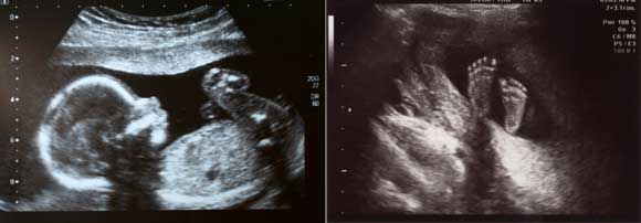 245491-fetus-ultrasound